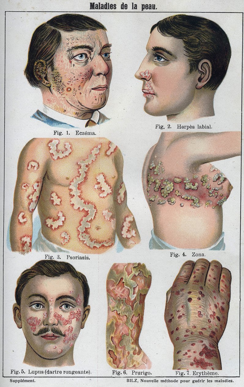 Skin diseases: Eczema, labial herpes, psoriasis, shingles, lapus (rotting darter), prurigo, erytheme.” The new natural medication”” by F.E. Bilz. av Unknown artist