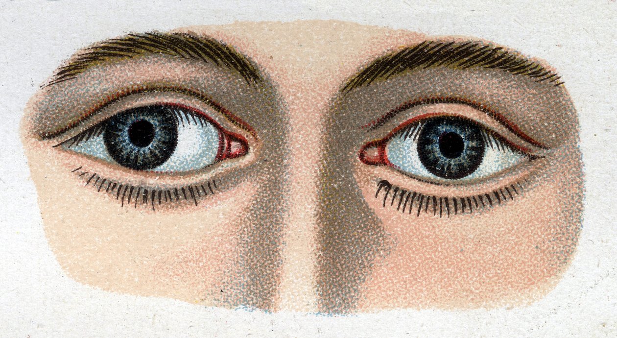 Strabismus divergerende. "Den nye naturlige medisinen" av F.E. Bilz. av Unknown artist