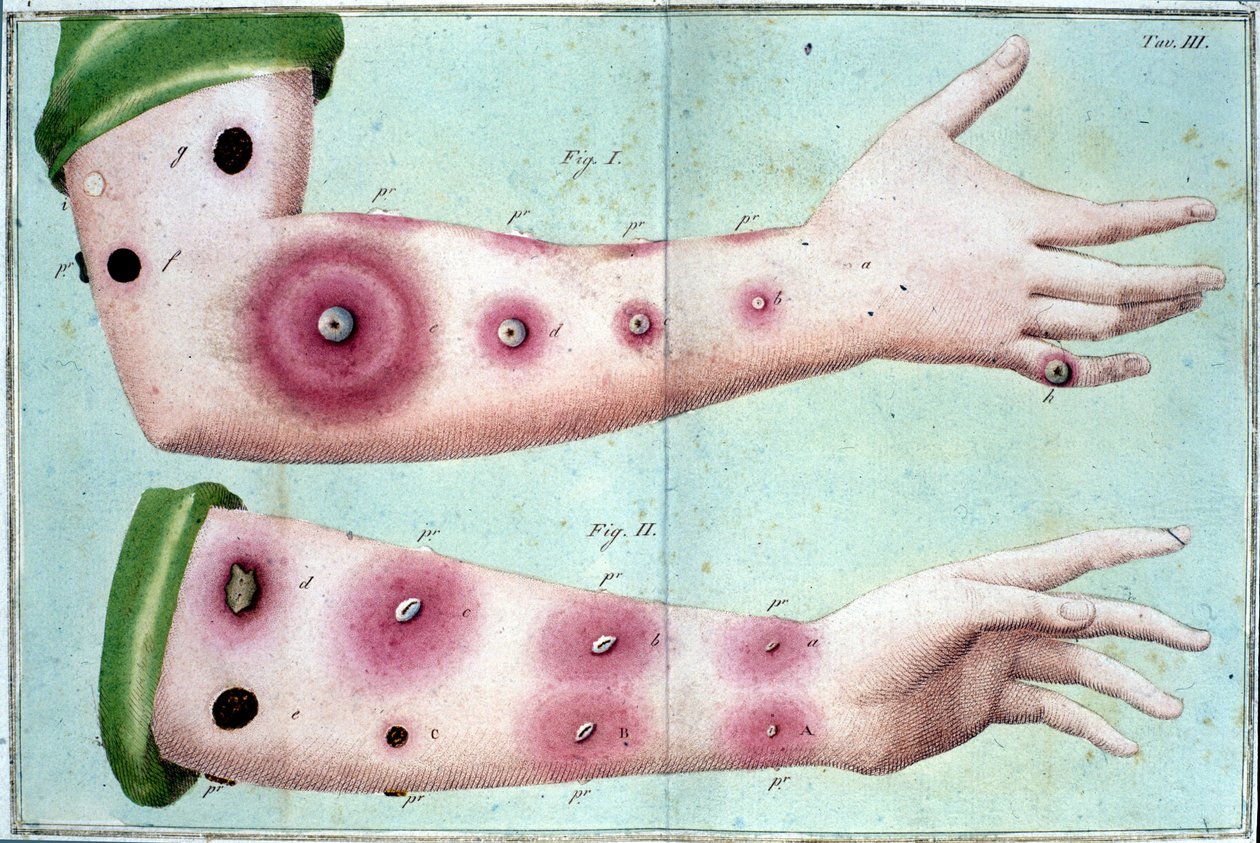Symptomer på koppesykdom som forårsaker et utbrudd av pustler på huden. Medisinsk plate fra "" Vaccination Treat" av Luigi Sacco, Milano av Unknown artist