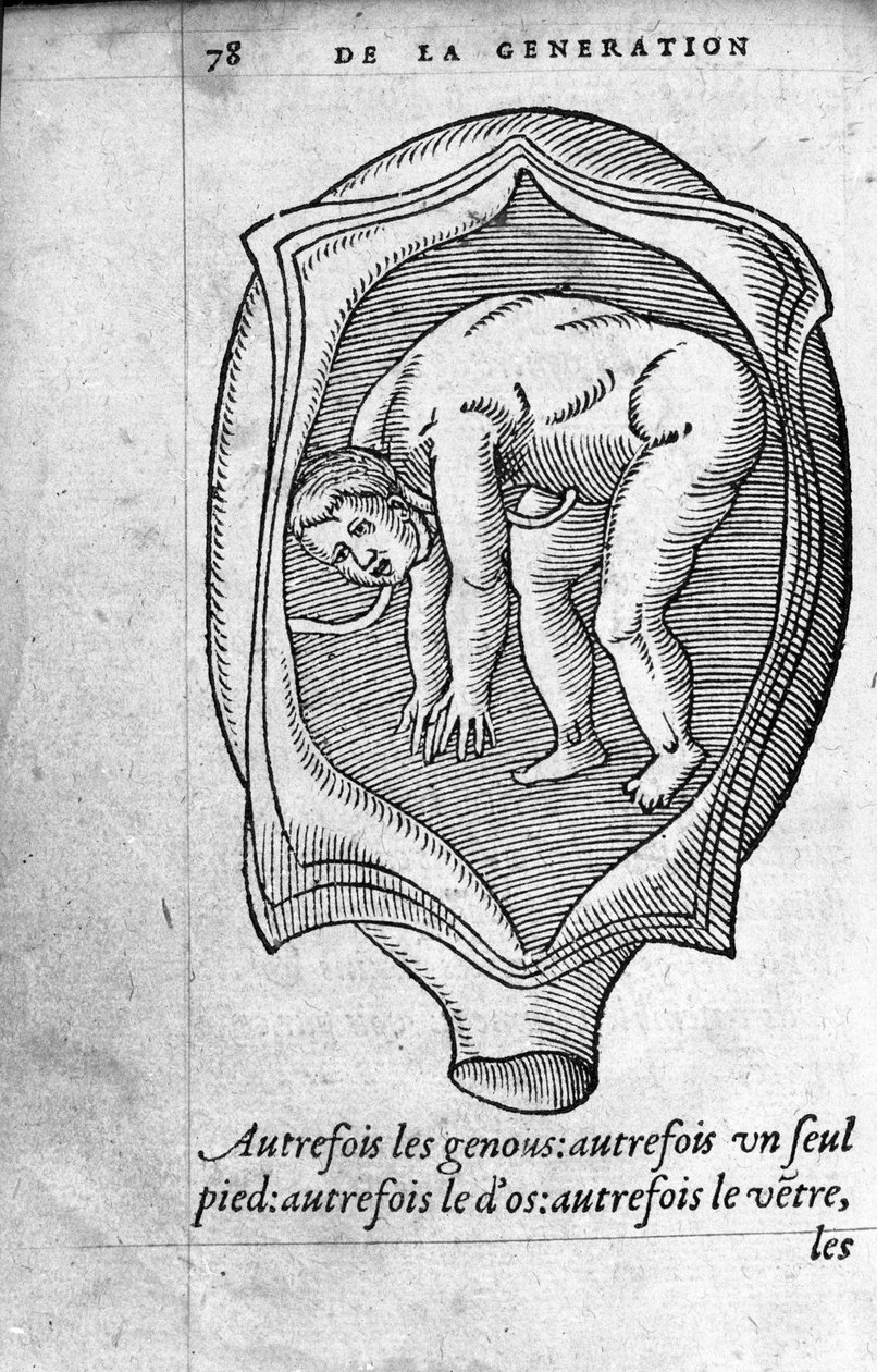 Fosterets posisjon i livmoren under graviditet. Gravering fra "" De la generation des enfants"" av den franske legen og kirurgen Ambroise Pare (1509-1590) 1500-tallet av Unknown artist