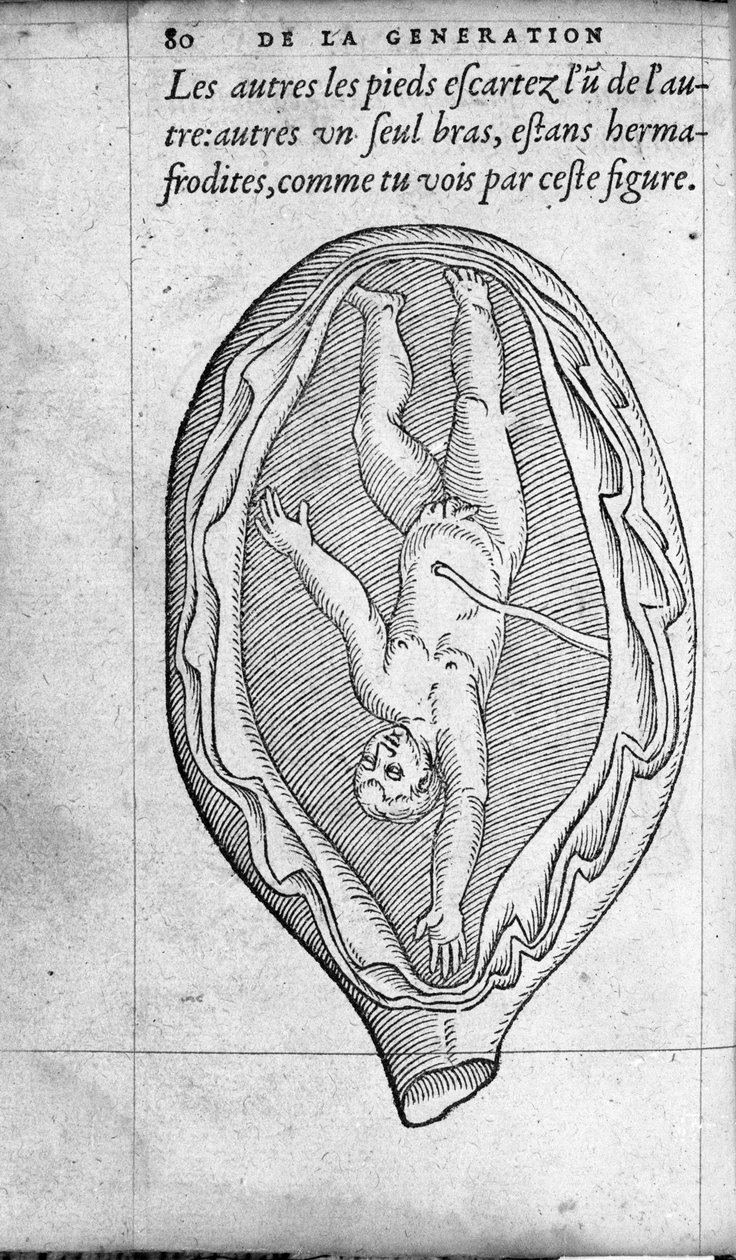 Fosterets posisjon i livmoren under graviditet. Gravering fra "" De la generation des enfants"" av den franske legen og kirurgen Ambroise Pare (1509-1590) 1500-tallet av Unknown artist