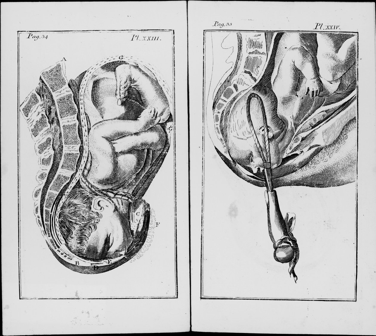Fødsel av en baby med bruk av tang Plate fra "An abridgement of the practice of midwifery"" av William Smellie (1697-1763) av Unknown artist