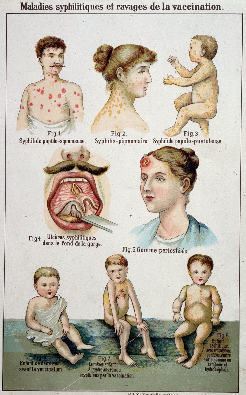 Plate som illustrerer de forskjellige sovesalene til syfilittiske sykdommer og farene ved vaksinasjon - i Bilz naturmedisin, sent på 1800-tallet. av Unknown artist