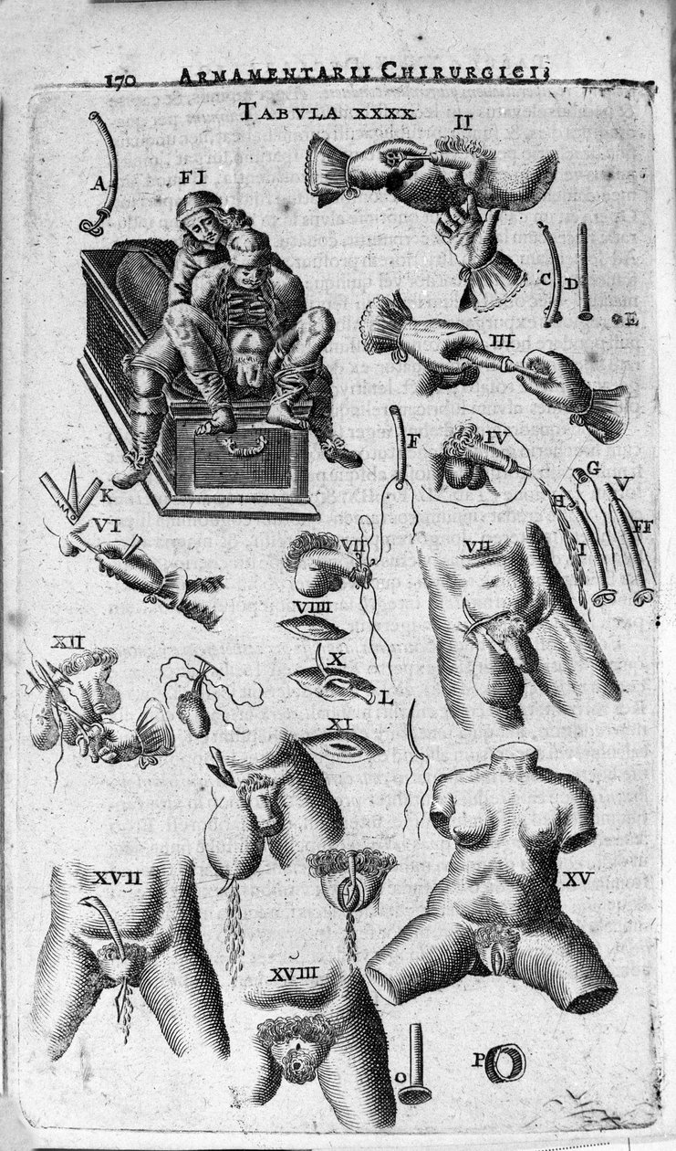 Kirurgiske inngrep på kvinne- og mannkjønn. Gravering i «Armamentarium Surgical» av J. Scultetus, Venezia av Unknown artist