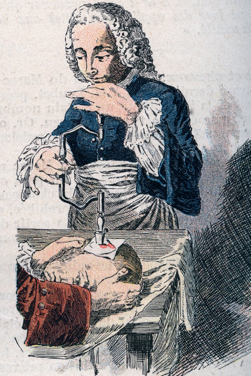 Trepanasjonen. 1700-tallstrykk. av Unknown artist