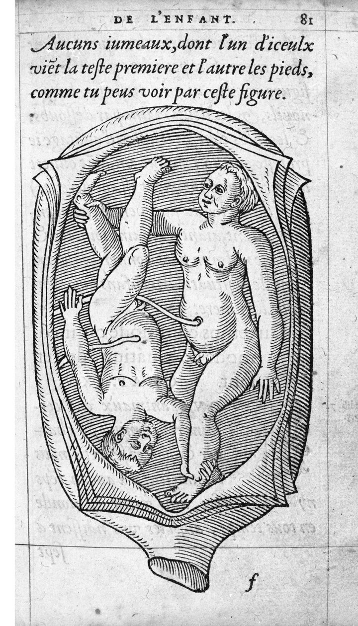 Posisjonen til fosteret i livmoren under graviditet. Gravering fra "" De la generation des enfants"" av den franske legen og kirurgen Ambroise Pare (1509-1590) 1500-tallet av Unknown artist