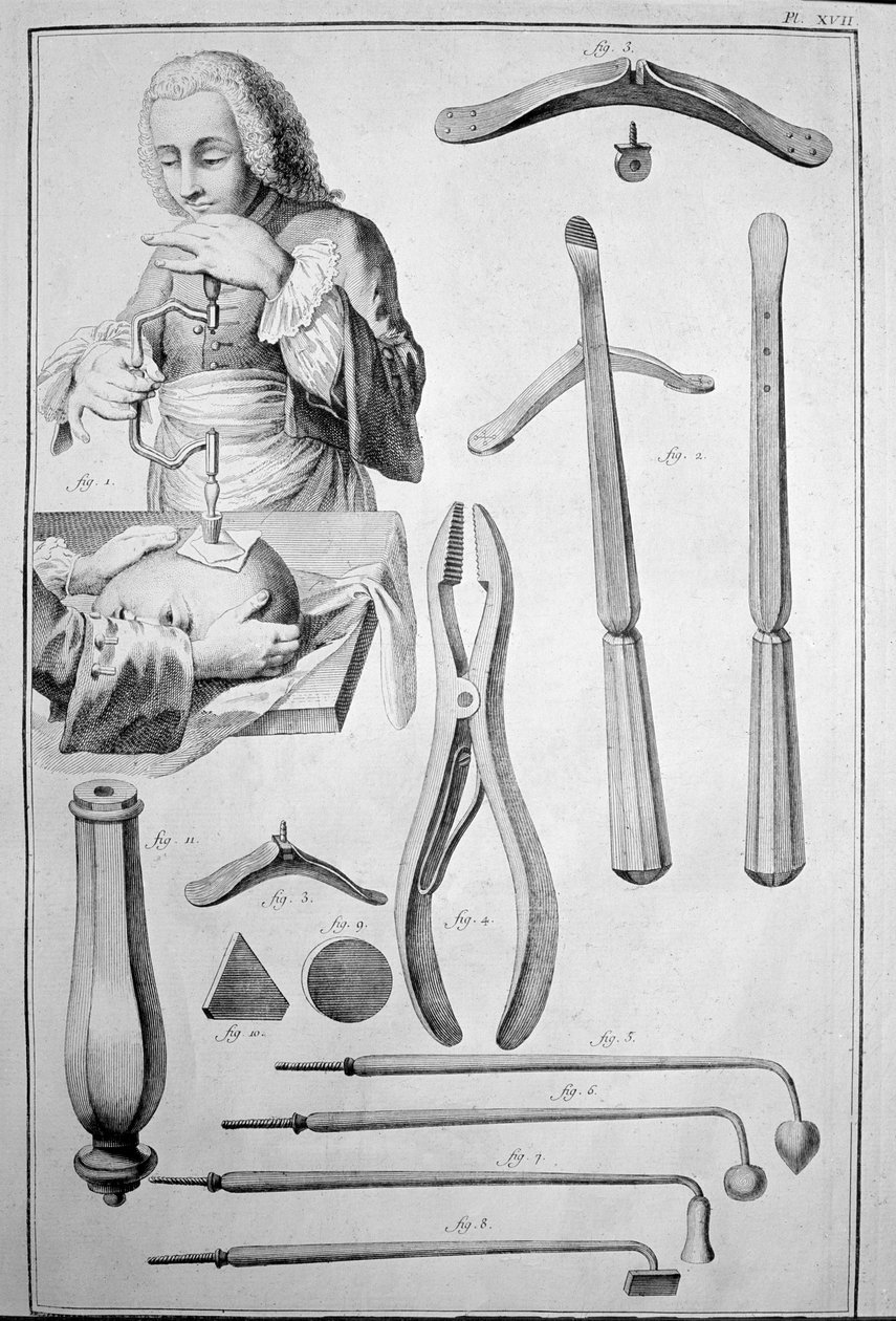 Trepanering av hodeskallen, forskjellige instrumenter (gravering av Unknown artist