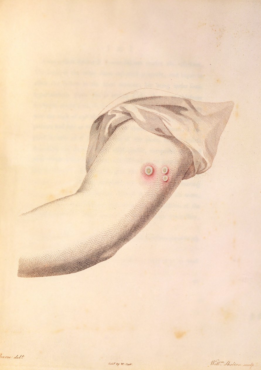 Arm of William Pead brukt til koppevaksine, fra 