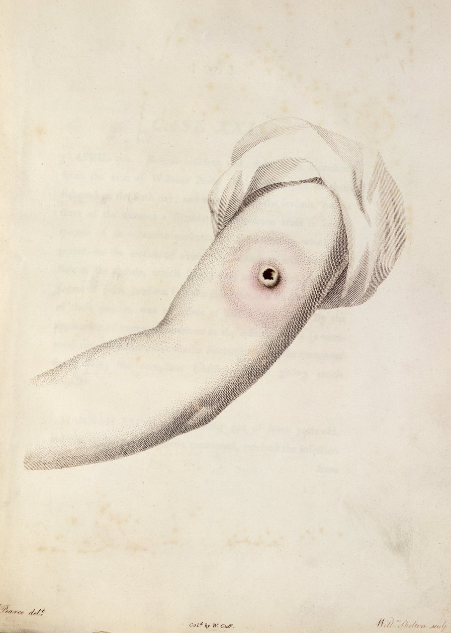 Cowpox pustel på en arm, fra 'An Inquiry into the Causes and Effects of the Variolae Vaccinae' av Edward Jenner (1749-1823) gravert av Pearce, ca. 1800 av William Skelton