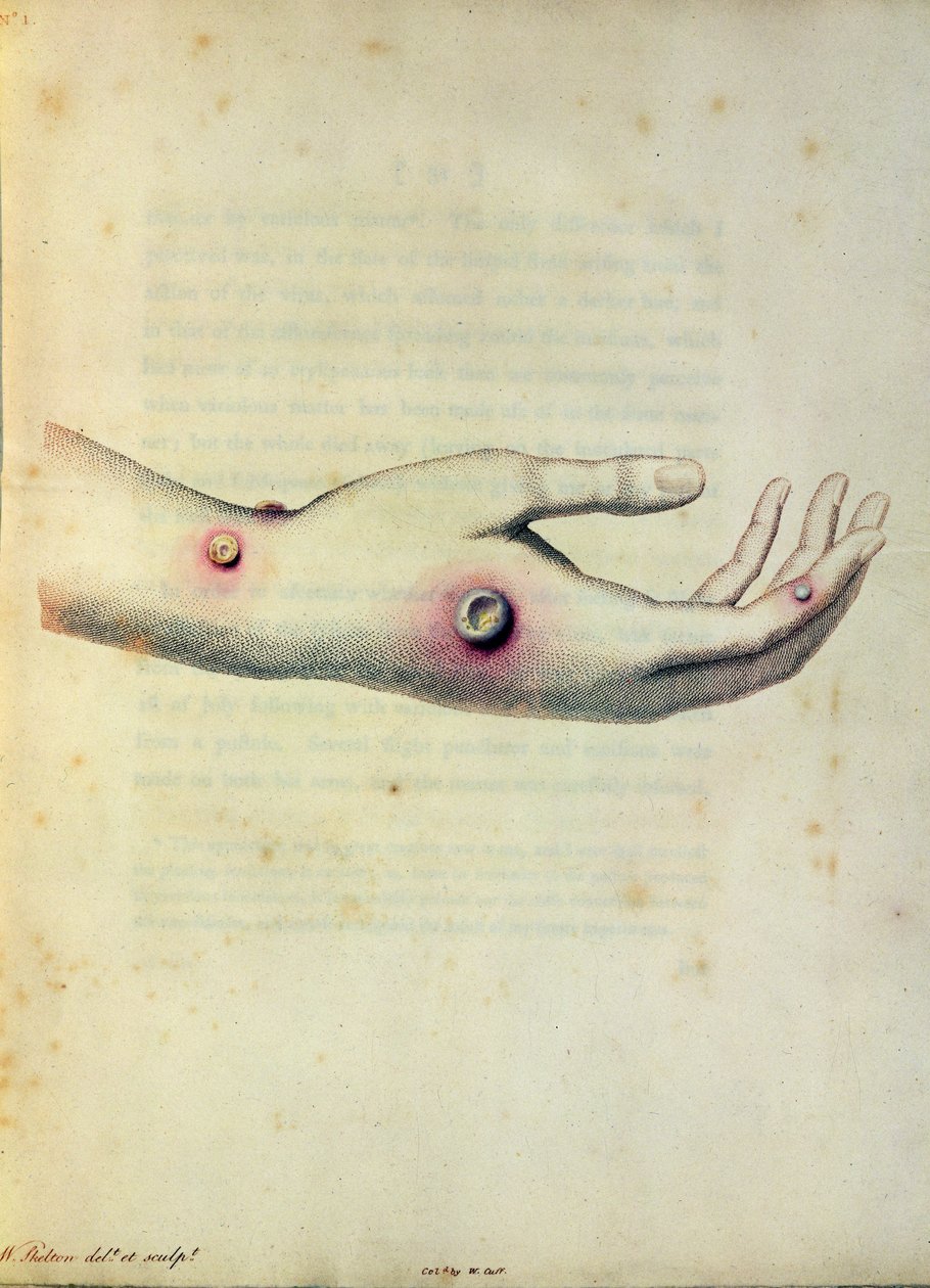 Cowpox pustle på armen til Sarah Nelmes, fra 