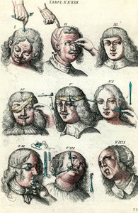 Kirurgi på 1700-tallet: Trepanasjon og operasjon av øyet og ansiktet. Gravering i "Institutionis chirurgicae" av Lorenzo Heister av Anonymous Anonymous