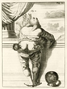 Et eksempel på kopping, fra The Practice of Medicine av Frederik Dekkers, 1694 av Dutch School