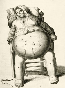 Drenering av væsker fra en abscess av Frederik Dekkers, 1694 av Dutch School