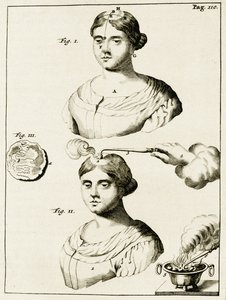 Behandling av en lider av epilepsi, fra Exercises in the Practice of Medicine av Frederik Dekkers, 1694 av Dutch School