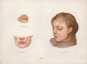 Hudsykdommer: Herpes (farge litho) av English School