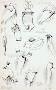 Metoder for å arrestere blødning, ca. 1890 av English School
