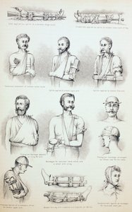 Midlertidig behandling av brudd, ca. 1890 av English School