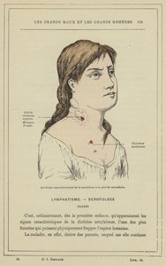Karakteristiske ulykker av skrofulose i sekundærperioden (farge litho) av French School