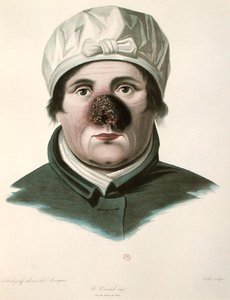 Før en hudtransplantasjonsoperasjon, fra 
