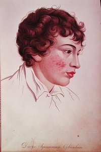 Tørr lapp, fra 'Description des Maladies de la Peau' av baron Jean Louis Alibert (1768-1837) av French School