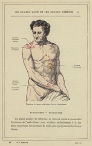 Utbrudd av leddgikt hos en revmatisk pasient (farge litho) av French School