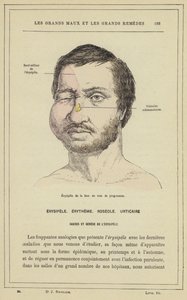 Progressiv ansikts erysipelas (farge litho) av French School