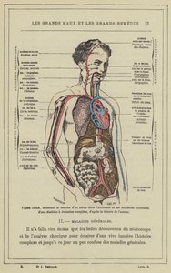 Ideell figur, som viser fremgangen til et virus i økonomien og de påfølgende ulykkene til en diatese med fullstendig evolusjon, i henhold til forfatterens teori (farge litho) av French School