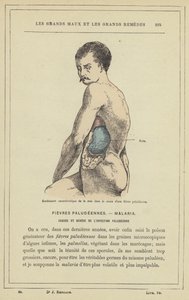 Karakteristisk hevelse i milten i løpet av malariafeber (farge litho) av French School