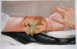 Hospital Gangrene, fra 