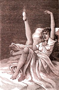 Hysteri, et ekstremt mentalt fenomen, psykoser og psykoneurose.1887 (gravering) av French School