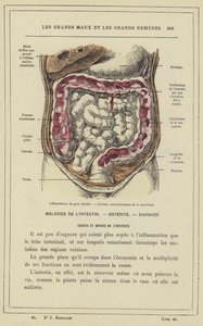 Betennelse i tykktarmen, lesjoner som er karakteristiske for dysenteri (farge litho) av French School