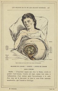 Areolar cyste i høyre eggstokk i full utvikling (farge litho) av French School