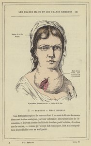 Cloisonne serøs cyste i nakken, Lipoma i hodet (farge litho) av French School