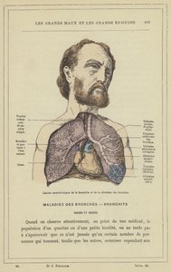 Lesjoner karakteristiske for bronkitt og bronkial dilatasjon (farge litho) av French School