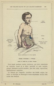 Karakteristiske lesjoner av tyfoidfeber (farge litho) av French School