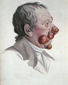 Mycosis Fongoide, fra en bok av Baron Jean Louis Alibert (1768-1837) 1838 (farget gravering) av French School