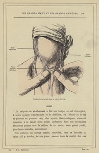 Posisjon av lansetten i armblødningen (farge litho) av French School
