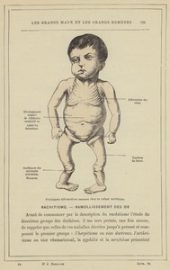 Hovedbeindeformasjoner hos et barn med rakitt (farge litho) av French School