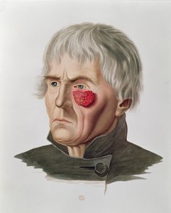 Hudsykdom før en operasjon, fra Selecta Praxis Medico-Chirurgica av Alexander Auvert, Paris, 1856 av French School