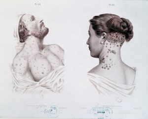 Symptomer på syfilis hos menn og kvinner, fra en medisinsk bok, ca. 1850-60 av French School