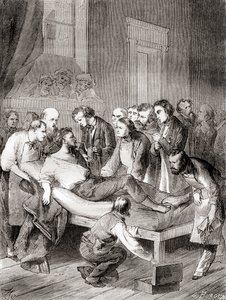 Den første offentlige demonstrasjonen av bruken av inhalert eter som et kirurgisk bedøvelsesmiddel i 1846 av en amerikansk tannlege, William Thomas Green Morton, fra 'Les Merveilles de la Science', publisert ca. 1870 av French School
