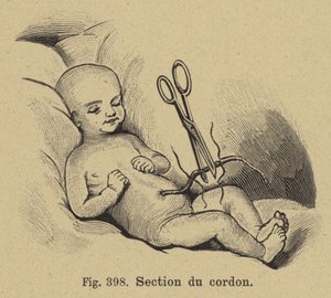 Klipp av en nyfødt babys navlestreng av German School