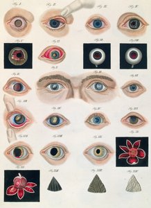 Beskrivelse av medfødte øyeanomalier, fra kliniske presentasjoner av sykdommer og visuelle defekter i det menneskelige øyet, av Friedrich August von Ammon (1799-1861) 1838 av German School