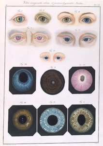 Beskrivelse av medfødte øyeanomalier, fra kliniske presentasjoner av sykdommer og visuelle defekter i det menneskelige øyet, av Friedrich August von Ammon (1799-1861) 1838 av German School