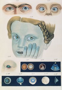 Beskrivelse av medfødte øyeanomalier, fra kliniske presentasjoner av sykdommer og visuelle defekter i det menneskelige øyet, av Friedrich August von Ammon (1799-1861) 1838 av German School