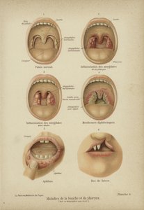 Sykdommer og lidelser i munn og svelg (farge litho) av German School