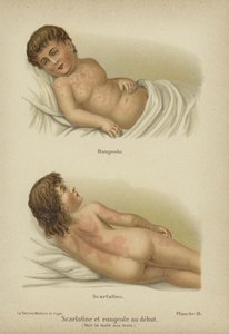 Tidlige symptomer på meslinger og skarlagensfeber (farge litho) av German School