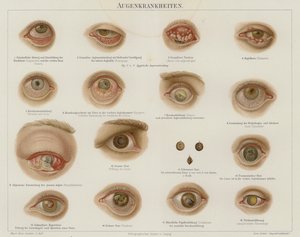 Øyelidelser (farge litho) av German School