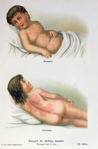 Meslinger og skarlagensfeber, fra en familiemedisinsk bok, ca. 1900 av Hungarian School