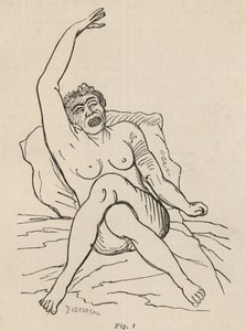 Hysterisk epilepsi, angrep, vridninger, fig. 1 fra 